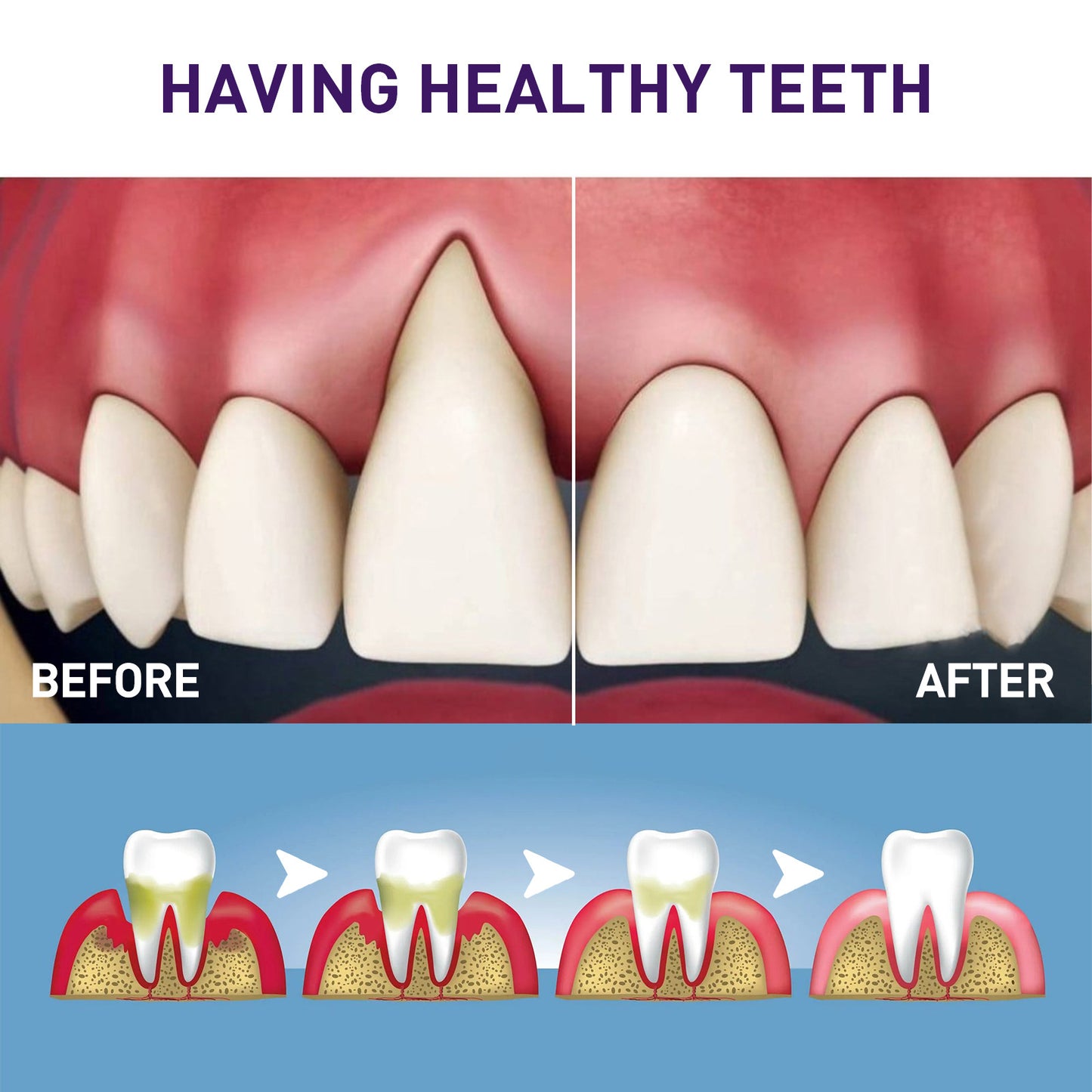 Teeth Whitening Pen & Gum Care Serum - Fast Stain Removal, Enamel Safe (3ml)
